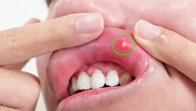 B Vitamini Eksikliği: 5 Belirgin Belirtiyi Keşfedin!
