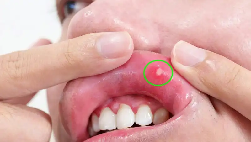 Kanserin Sessiz Uyarısı: Dilin Alınması Gereken Hayati Karar