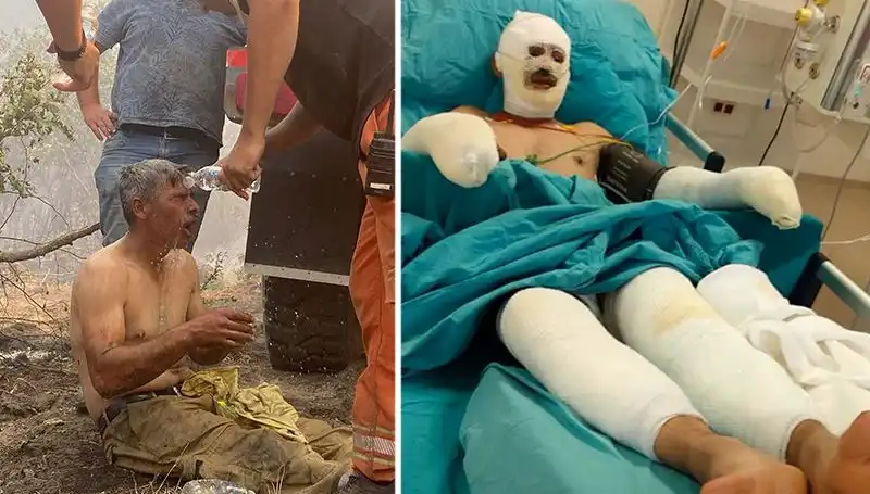 Orman İşçisinin "Yanıyorum" Feryadı, Hayati Tehlike Devam Ediyor!